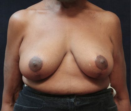 Breast Lift Before & After Patient #12743