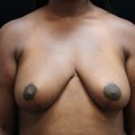 Breast Lift Before & After Patient #12758