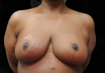 Breast Reduction Before & After Patient #12812