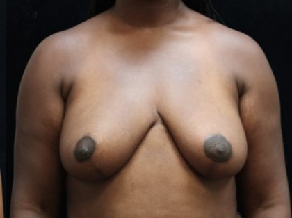 Breast Reduction Before & After Patient #12819