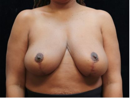 Breast Asymmetry Before & After Patient #12341