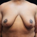 Breast Reduction Before & After Patient #12897