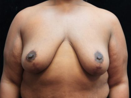 Breast Reduction Before & After Patient #12897