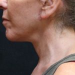 Chin Augmentation Before & After Patient #12904