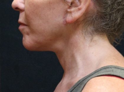 Chin Augmentation Before & After Patient #12904