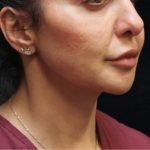 Chin Augmentation Before & After Patient #12913