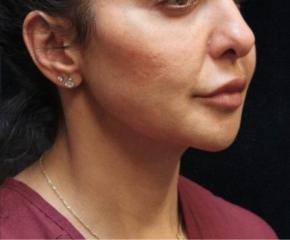 Chin Augmentation Before & After Patient #12913