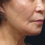 Chin Augmentation Before & After Patient #12929