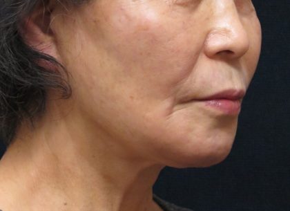 Chin Augmentation Before & After Patient #12929