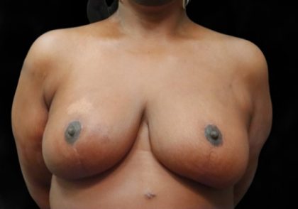 Breast Asymmetry Before & After Patient #13035