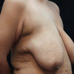 Breast Lift Before & After Patient #12410