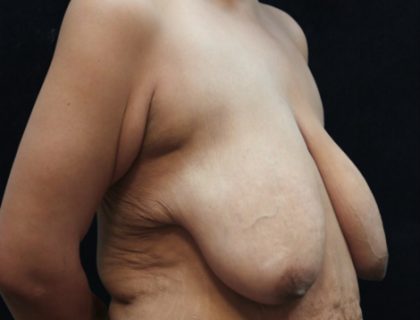 Breast Reduction Before & After Patient #12539