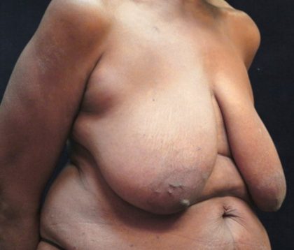 Breast Lift Before & After Patient #12743