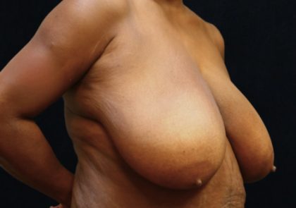 Breast Asymmetry Before & After Patient #12340