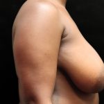 Breast Reduction Before & After Patient #12890