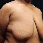 Breast Reduction Before & After Patient #12897