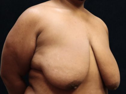 Breast Reduction Before & After Patient #12897
