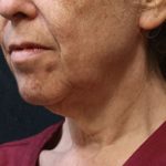 Chin Augmentation Before & After Patient #12904