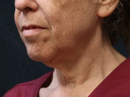 Chin Augmentation Before & After Patient #12904