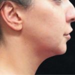 Chin Augmentation Before & After Patient #12913