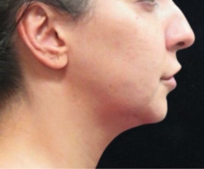 Chin Augmentation Before & After Patient #12913