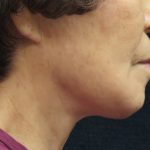 Chin Augmentation Before & After Patient #12929