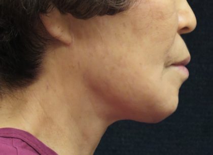 Chin Augmentation Before & After Patient #12929
