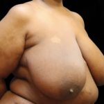 Breast Asymmetry Before & After Patient #13035