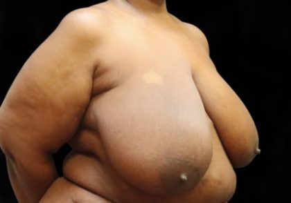 Breast Asymmetry Before & After Patient #13035