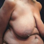Breast Reduction Before & After Patient #12801