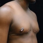 Breast Reduction Before & After Patient #12544