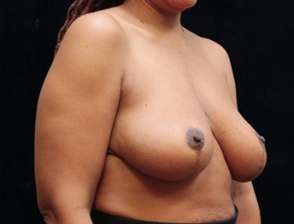 Breast Lift Before & After Patient #12724