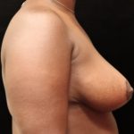 Breast Reduction Before & After Patient #12890