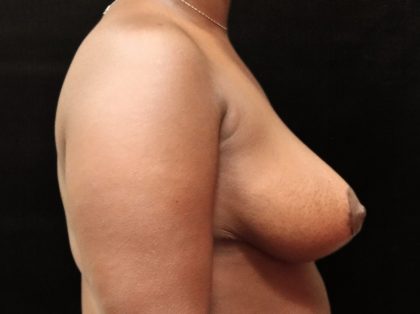 Breast Reduction Before & After Patient #12890