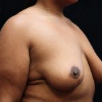 Breast Reduction Before & After Patient #12897