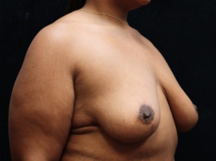 Breast Reduction Before & After Patient #12897