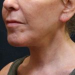Chin Augmentation Before & After Patient #12904