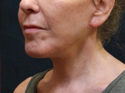 Chin Augmentation Before & After Patient #12904