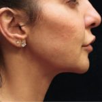 Chin Augmentation Before & After Patient #12913