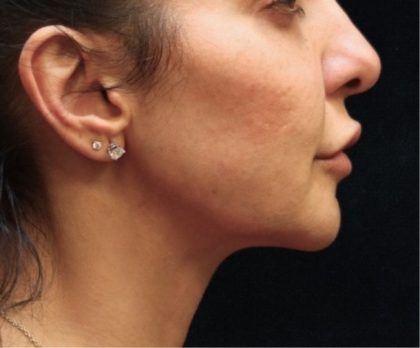 Chin Augmentation Before & After Patient #12913