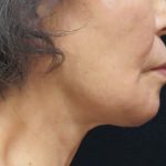 Chin Augmentation Before & After Patient #12929