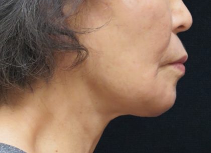 Chin Augmentation Before & After Patient #12929