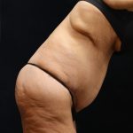Lower Body Lift Before & After Patient #13044