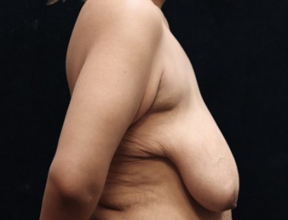 Breast Reduction Before & After Patient #12539