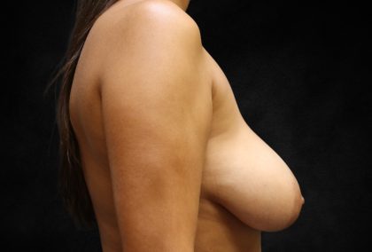 Breast Reduction Before & After Patient #12541