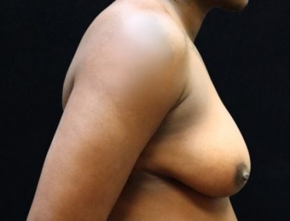 Breast Reduction Before & After Patient #12544