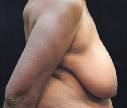 Breast Lift Before & After Patient #12743
