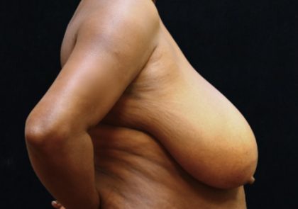 Breast Asymmetry Before & After Patient #12340