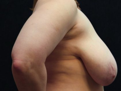 Breast Lift Before & After Patient #12793