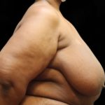 Breast Reduction Before & After Patient #12812